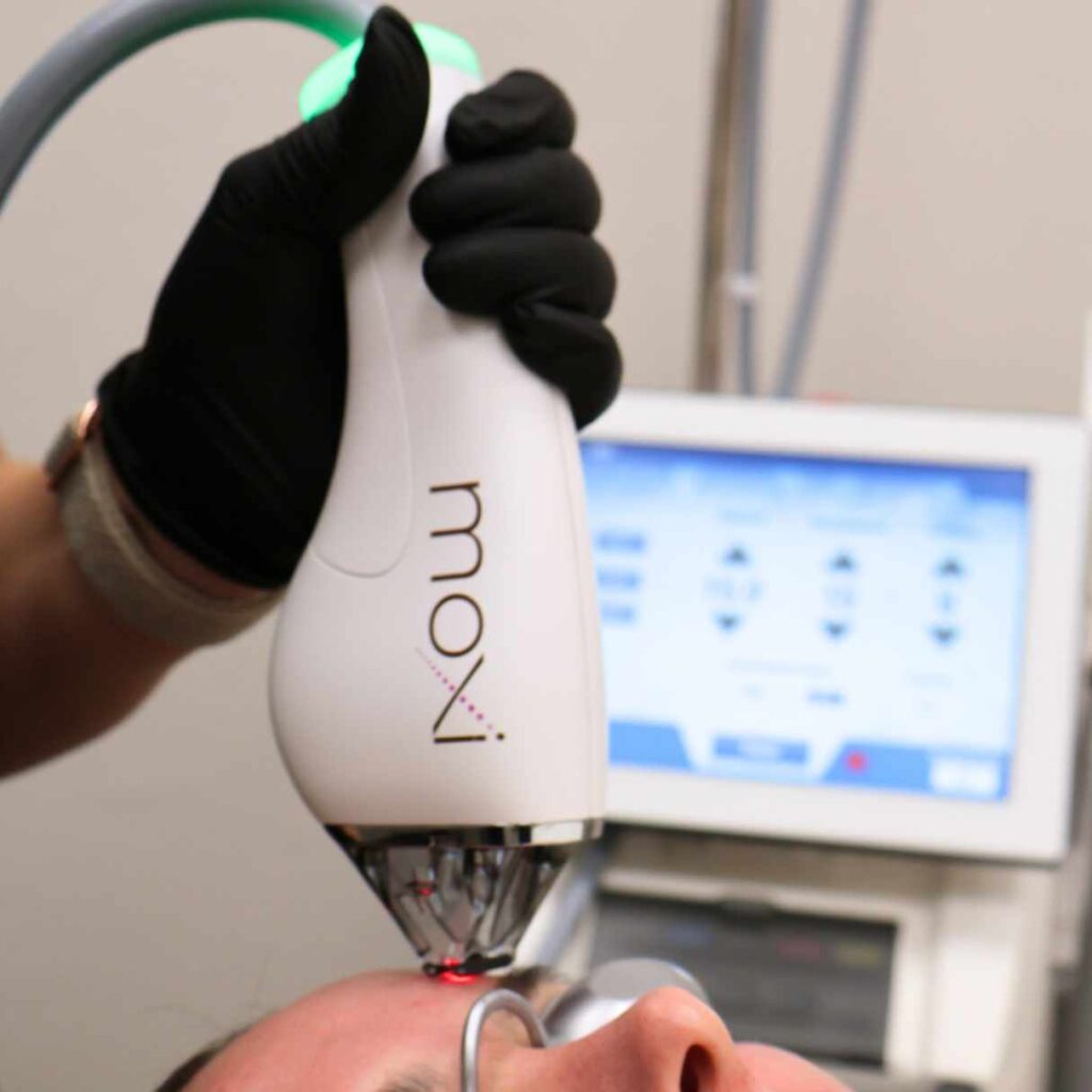 laser resurfacing in oklahoma city