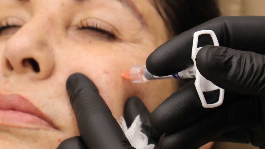 dermal fillers in cheek