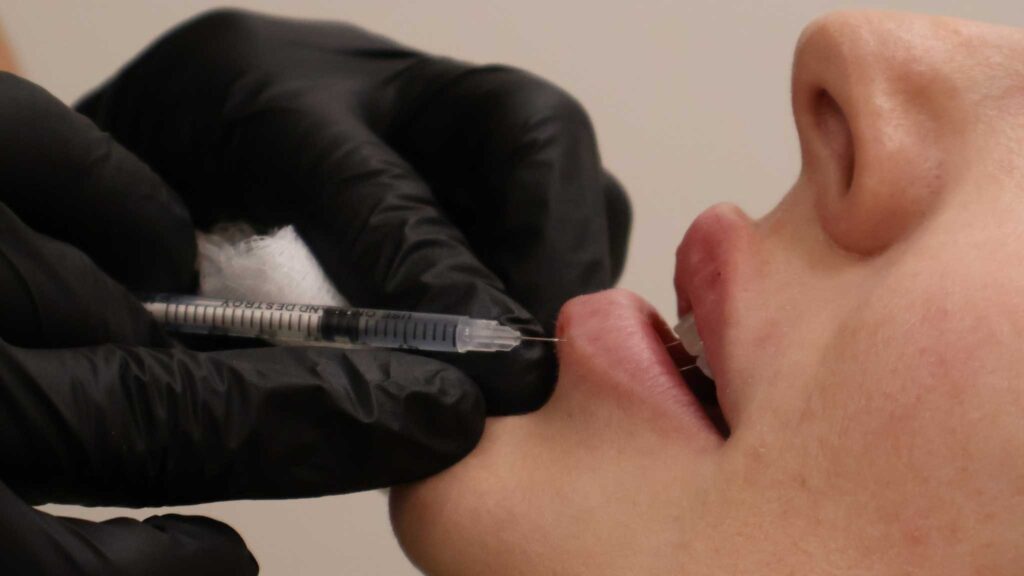 dermal fillers lip filler from the side