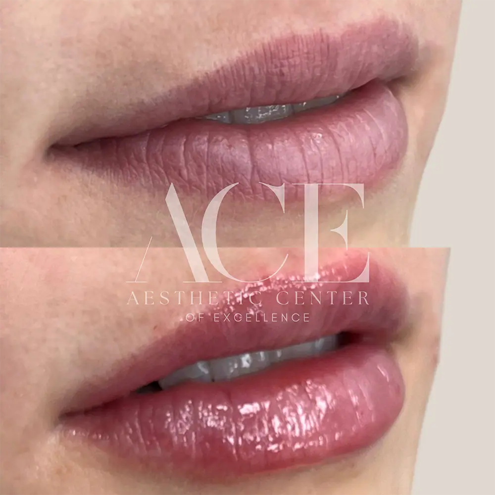 One Syringe of Lip Filler (2)