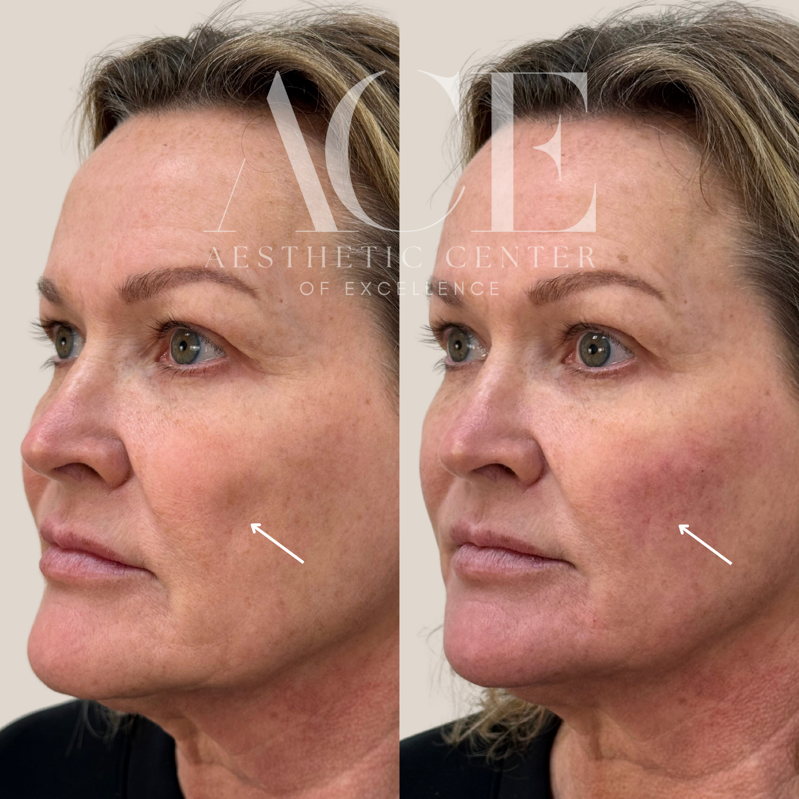 Dermal Filler