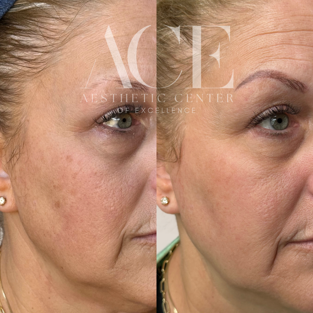 bbl and moxi before and after