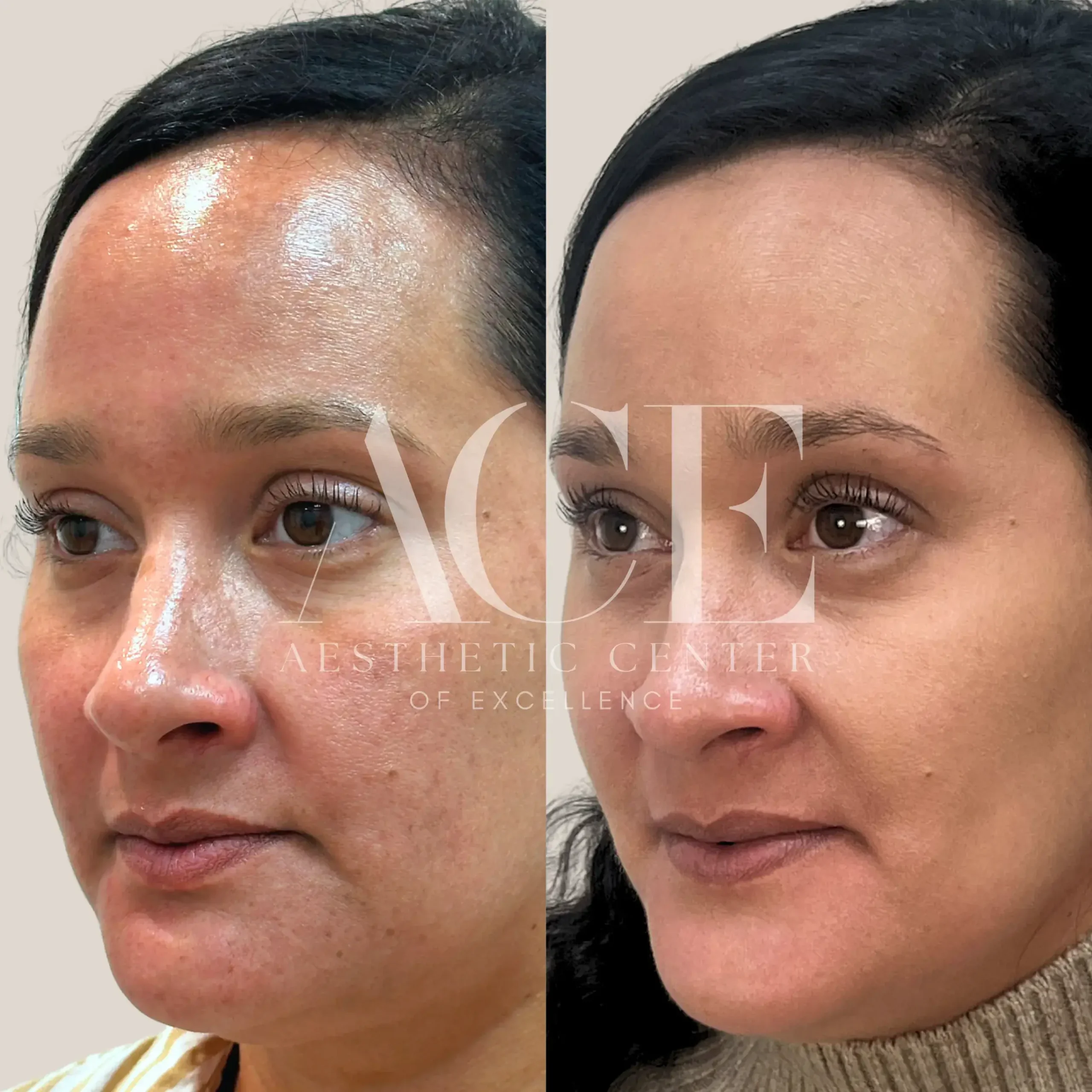 MOXI + ZO Pigment Control Protocol | Aesthetic Center of Excellence in Oklahoma City, OK