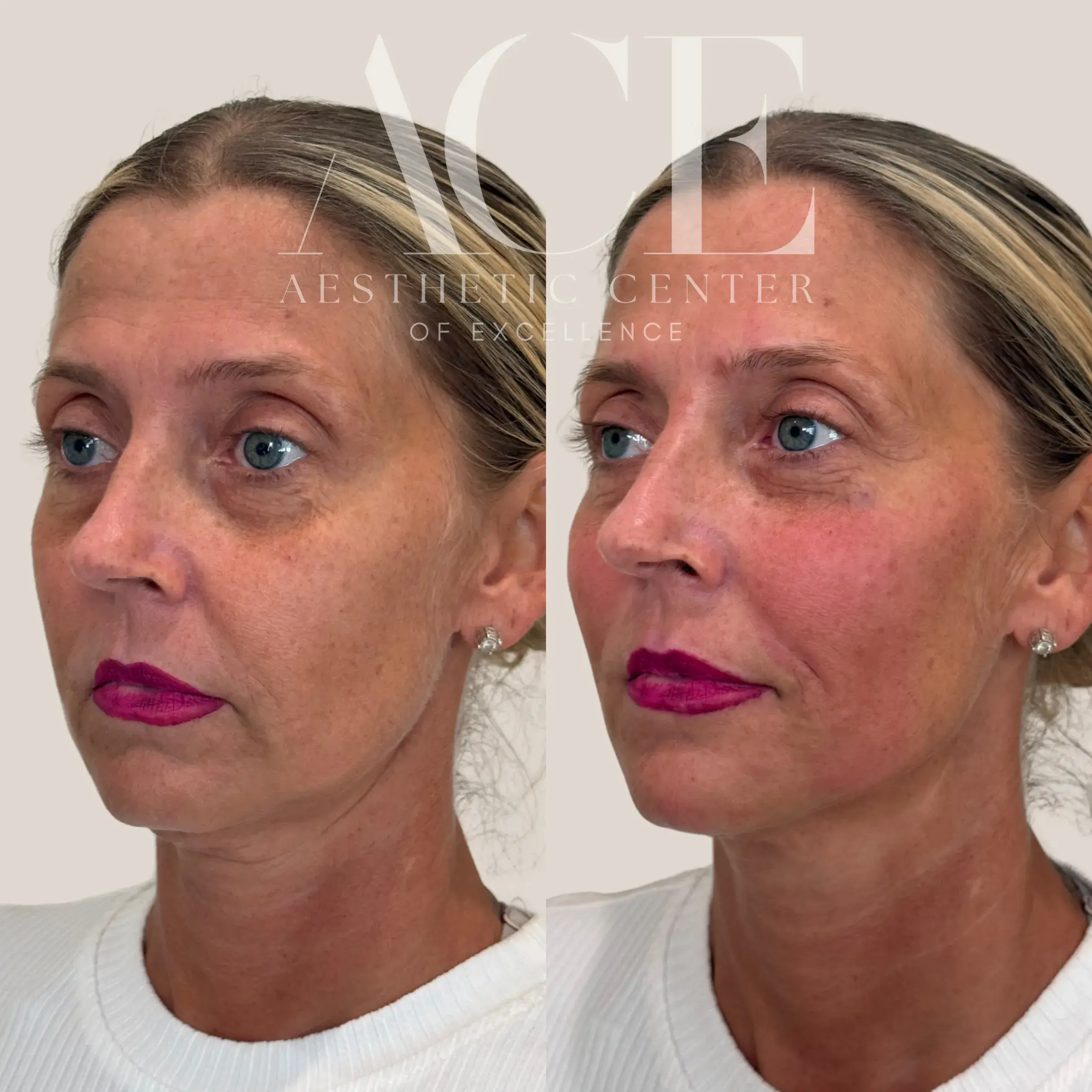 full face rejuvenation with filler injectables