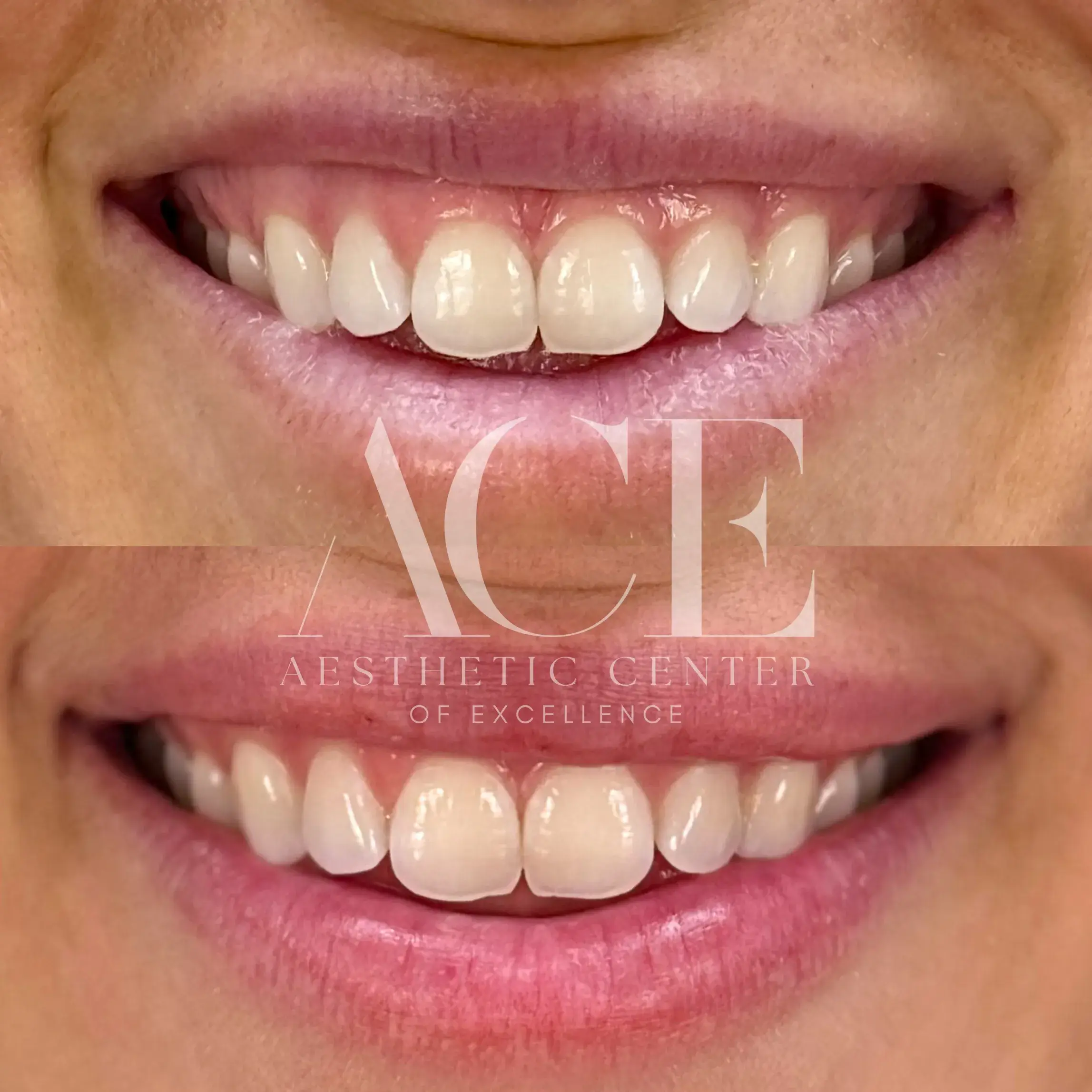 Lip Flip Botox Before and After Images in Oklahoma City, OK by Aesthetic Center of Excellence