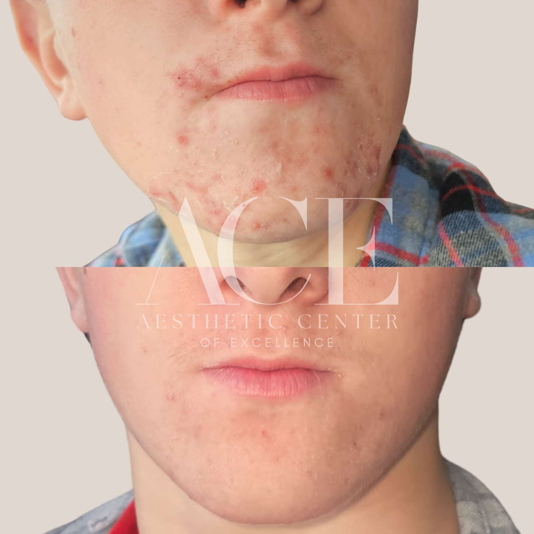 before and after of medical-grade skincare chin