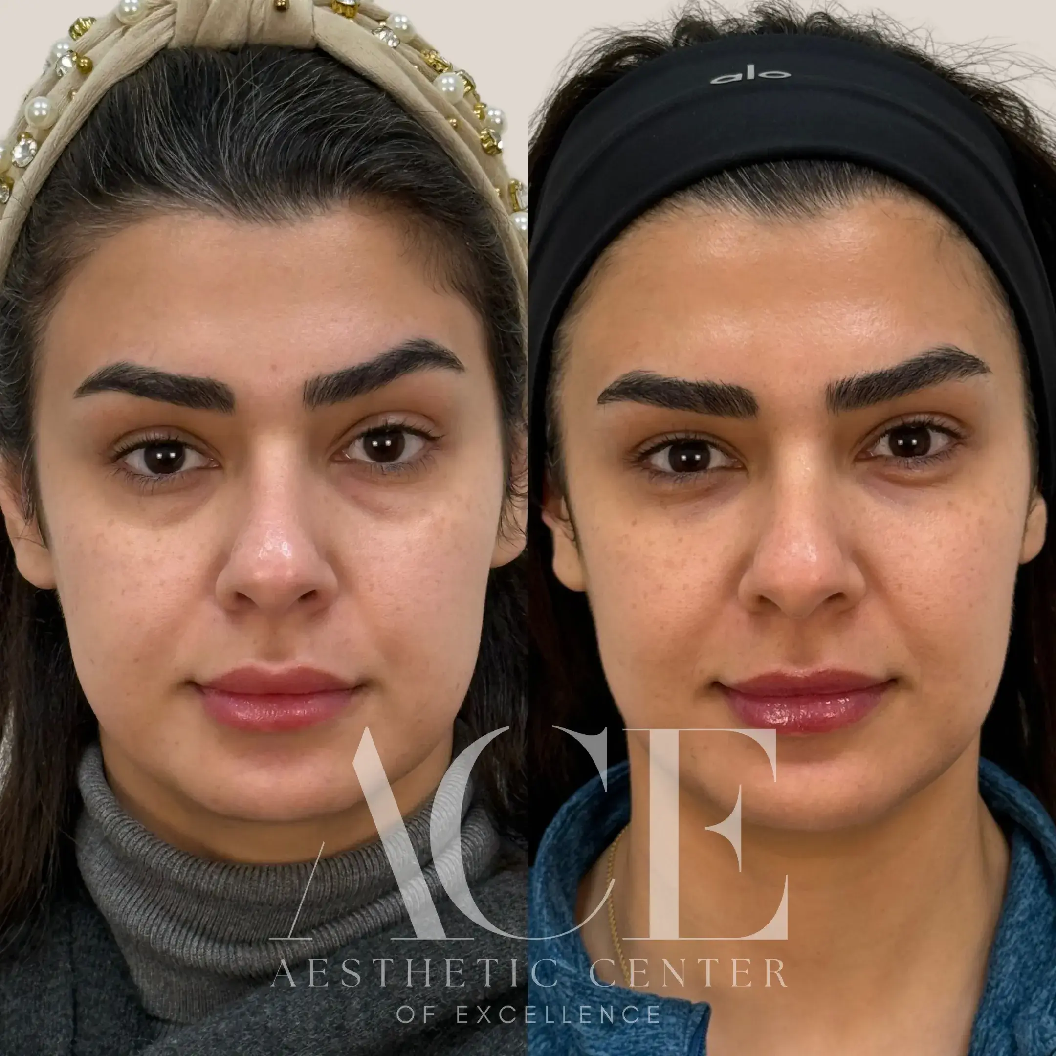 Tear Trough Medial Cheek Chin in Oklahoma City, OK by Aesthetic Center of Excellence