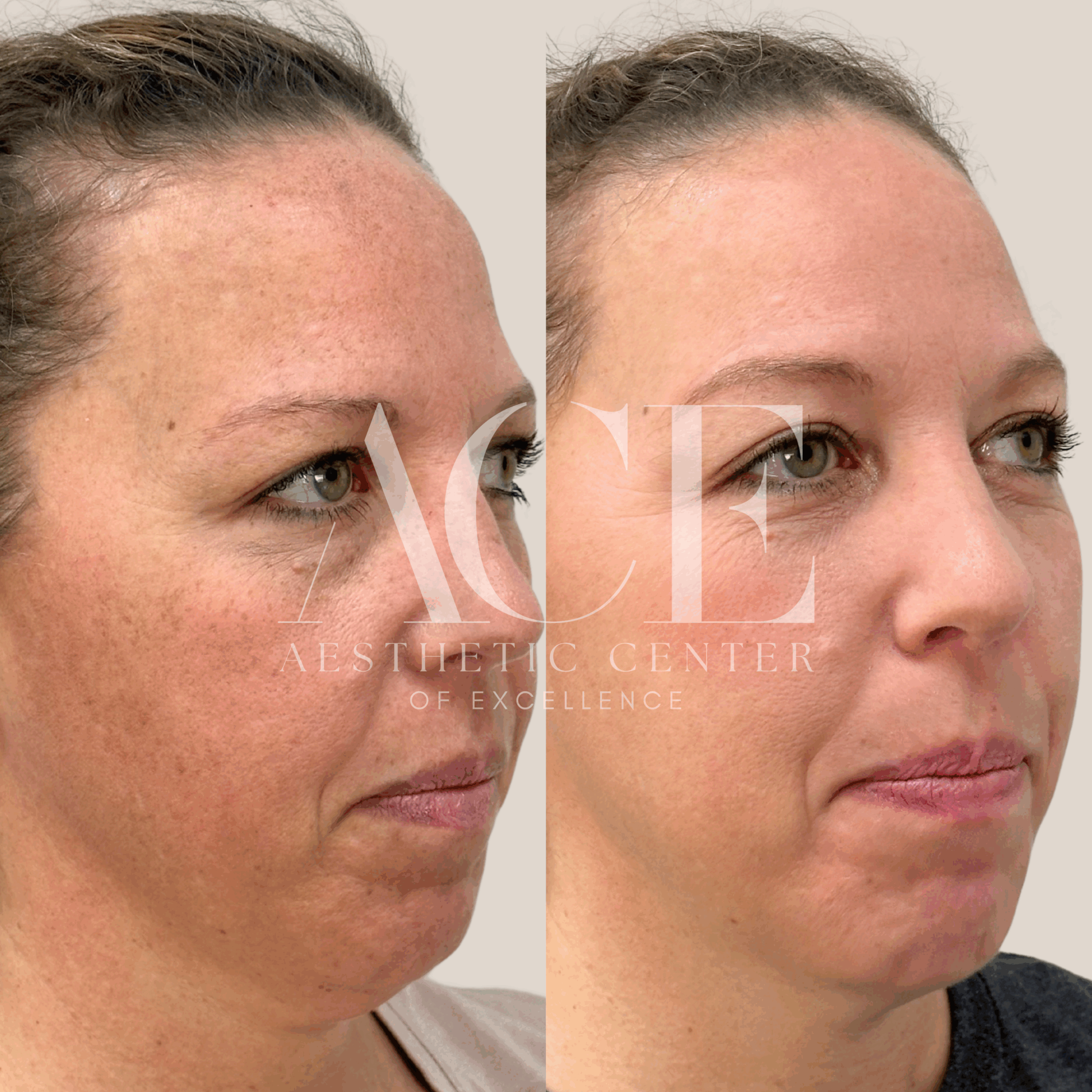 before and after medical grade skincare full face