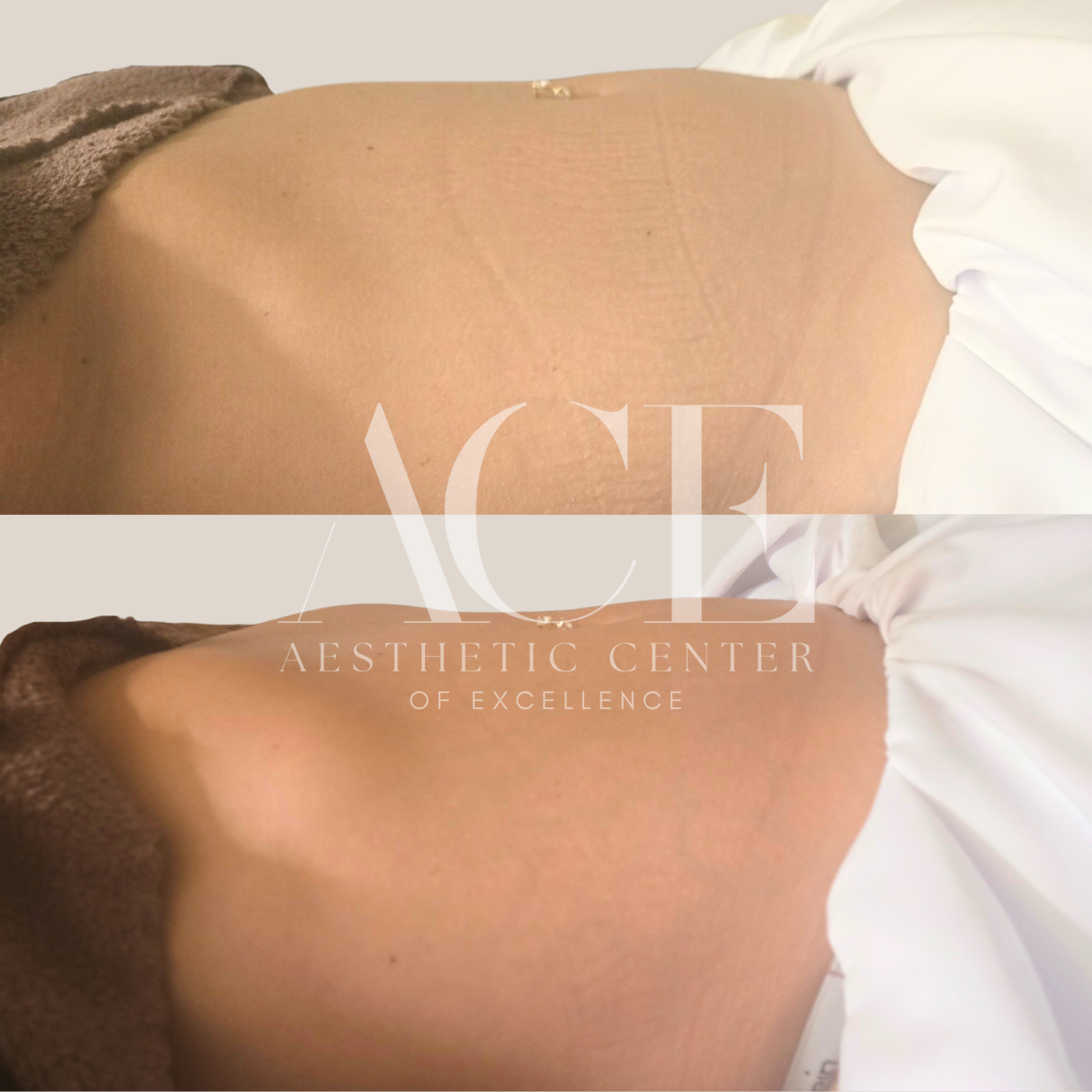 abdomen lymph drainage massage before and after oklahoma city