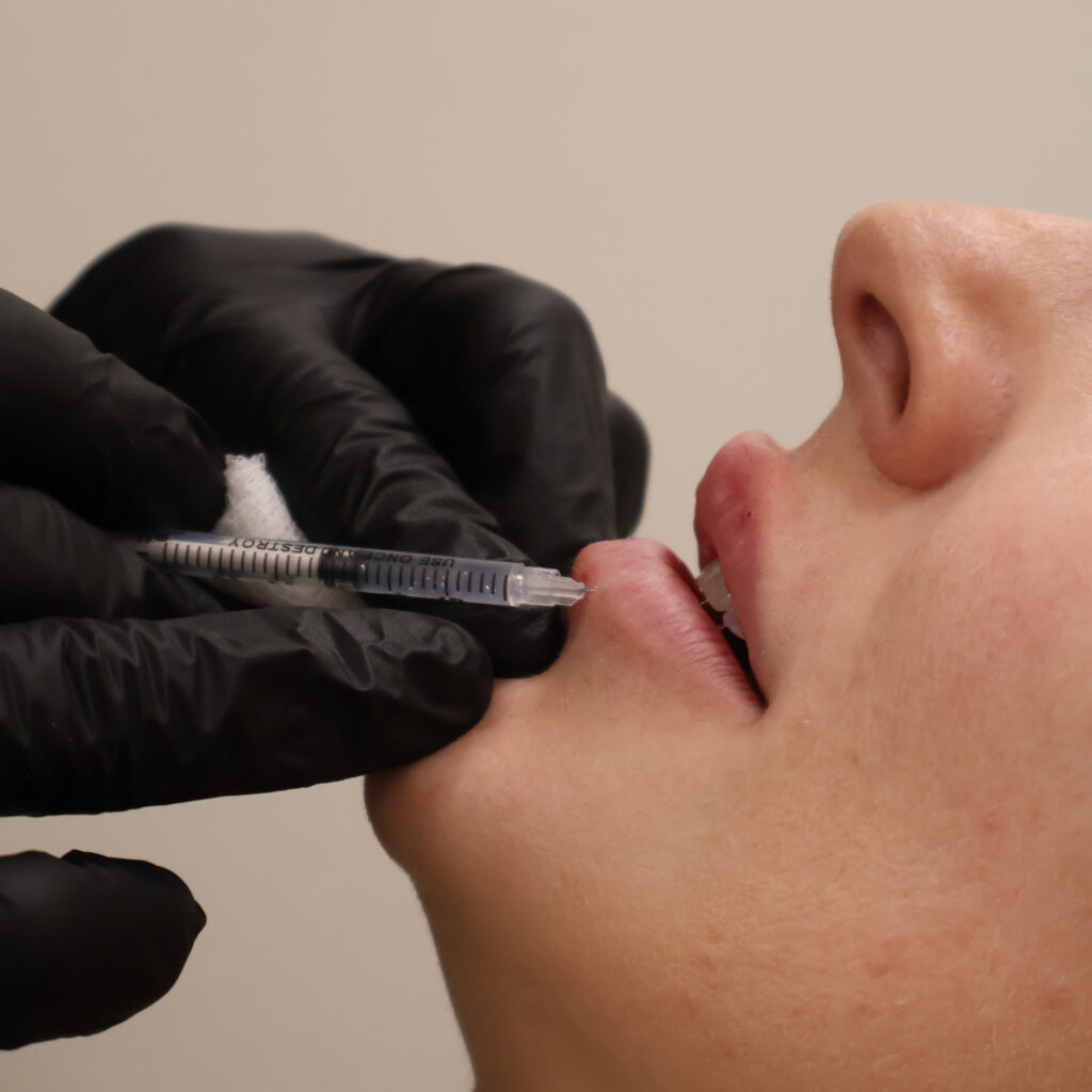 What Are The Side Effects Of Dermal Fillers? Side Effects Of Dermal Fillers | Aesthetic Center of Excellence in Oklahoma City, OK