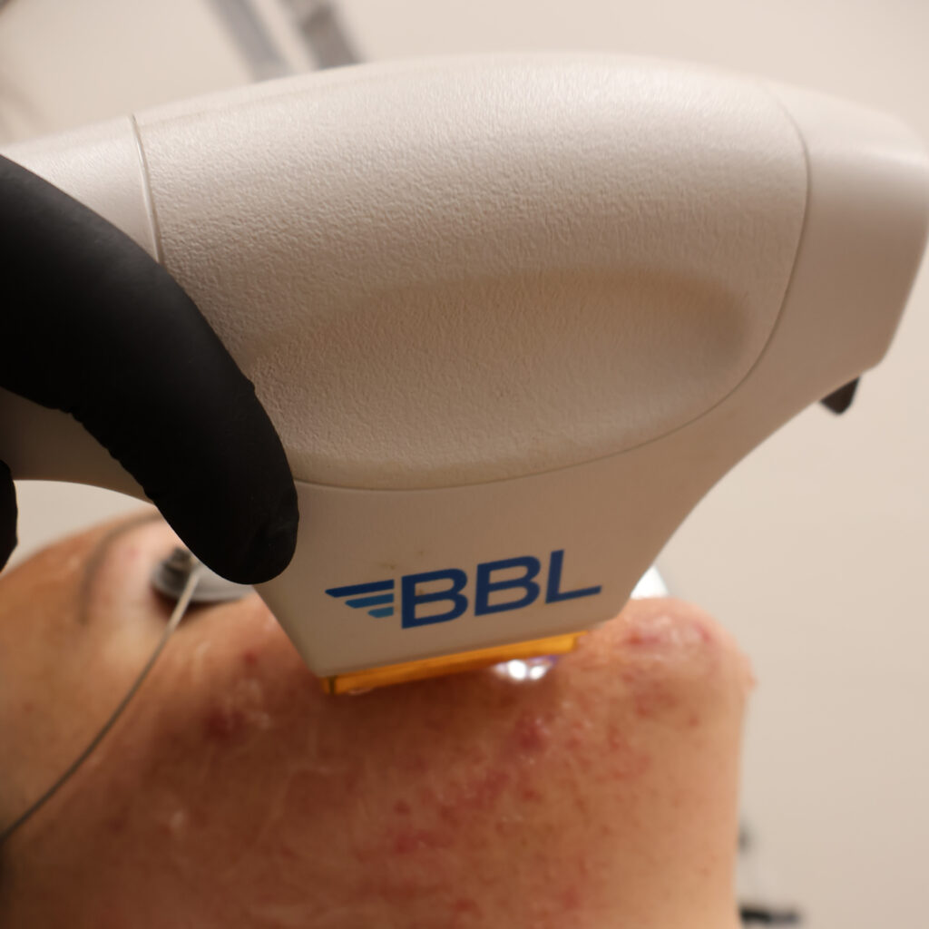 The Role of Skincare Products After a Photofacial Photofacial Treatment | Aesthetic Center of Excellence in Oklahoma City, OK