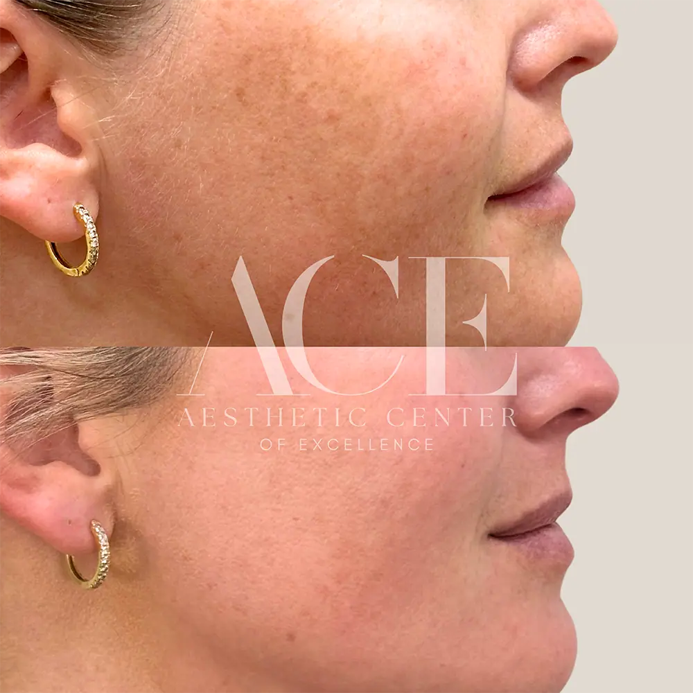 BBL and Moxi Laser Treatment Before And After | Aesthetic Center of Excellence in Oklahoma City, OK