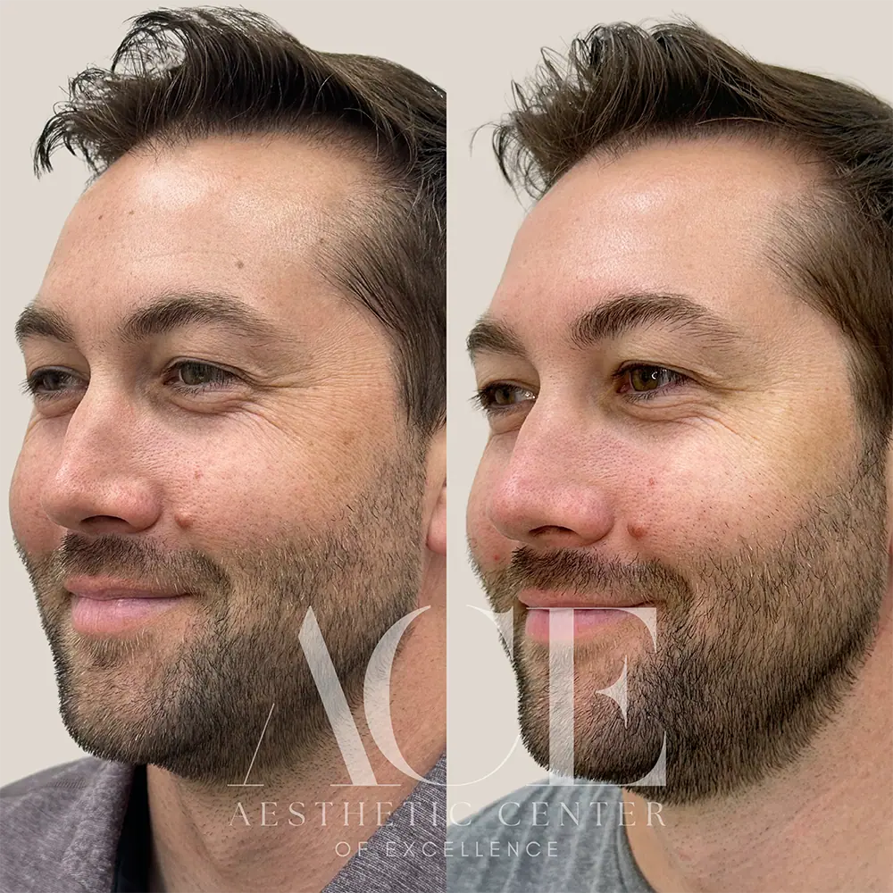 BBL Treatment Before and After | Aesthetic Center of Excellence in Oklahoma City, OK