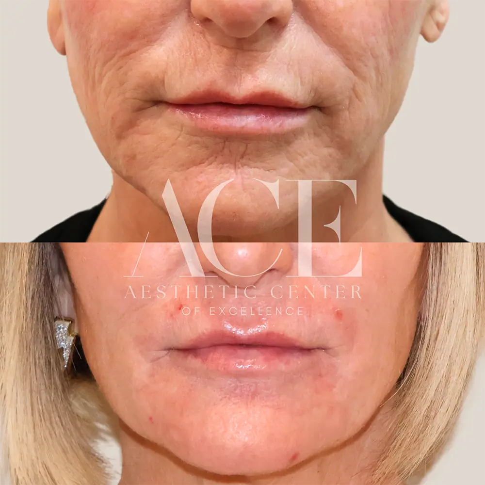 Before And After Lip Filler Treatment | Aesthetic Center of Excellence in Oklahoma City, OK