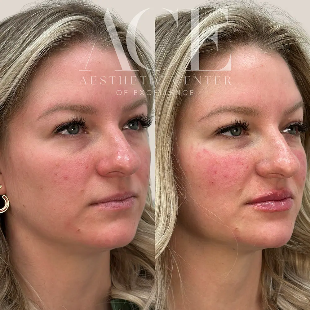 Filler and botox injectables combination treatment