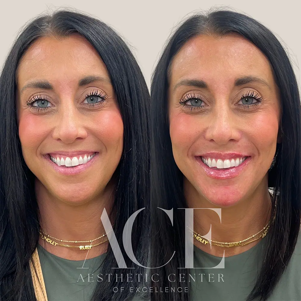 Filler and botox injectables combination treatment