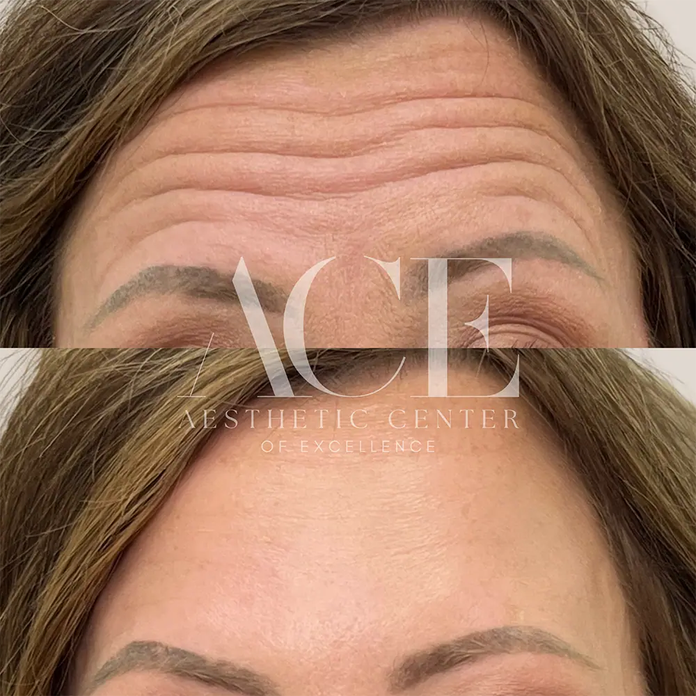 Forehead Botox Before and After | Aesthetic Center of Excellence in Oklahoma City, OK