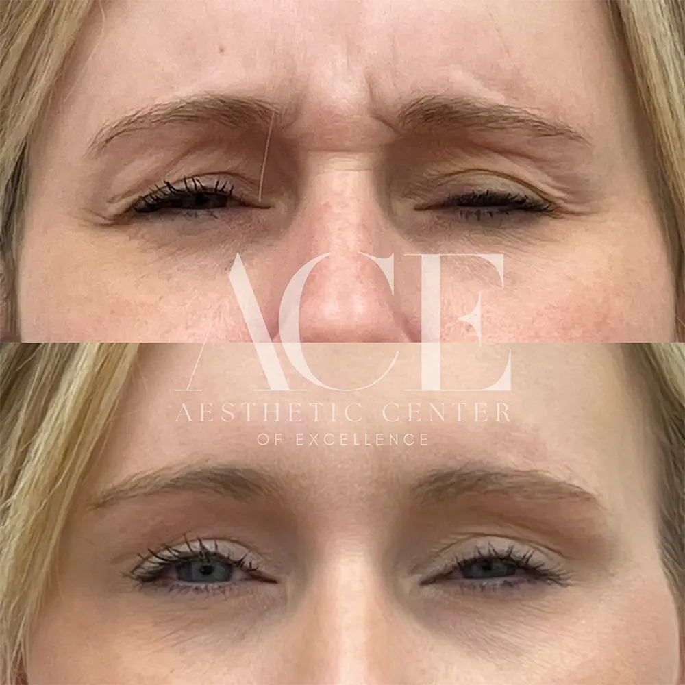 Frown Botox | Aesthetic Center of Excellence in Oklahoma City, OK