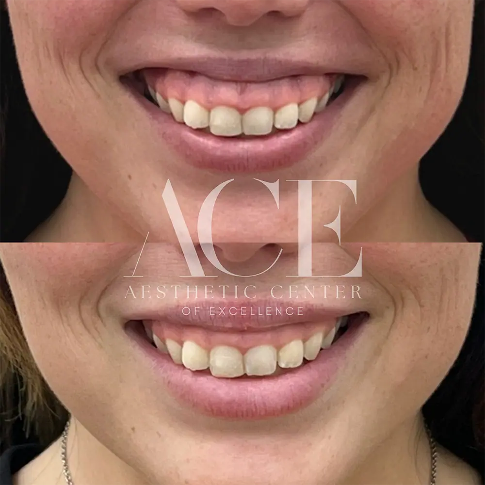 Gummy Botox | Aesthetic Center of Excellence in Oklahoma City, OK