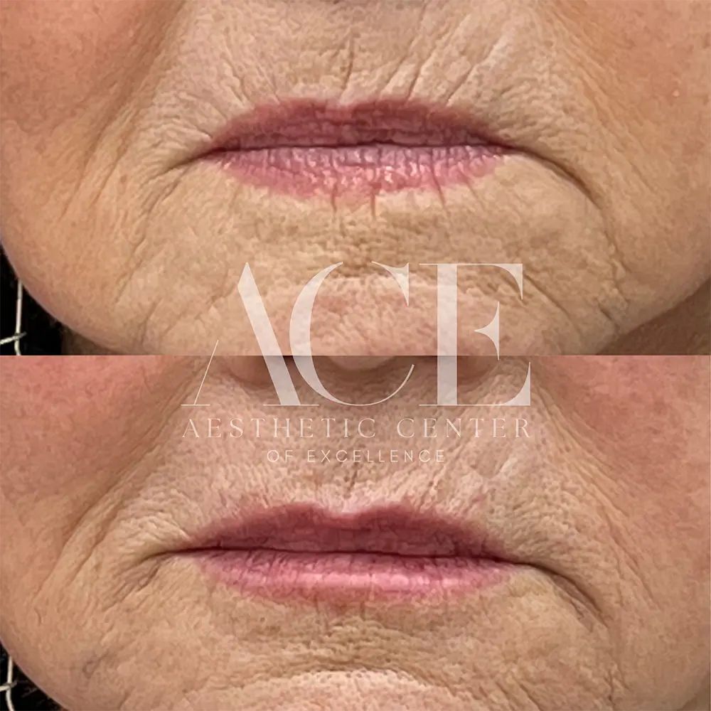 Before And After Lip Filler Treatment | Aesthetic Center of Excellence in Oklahoma City, OK