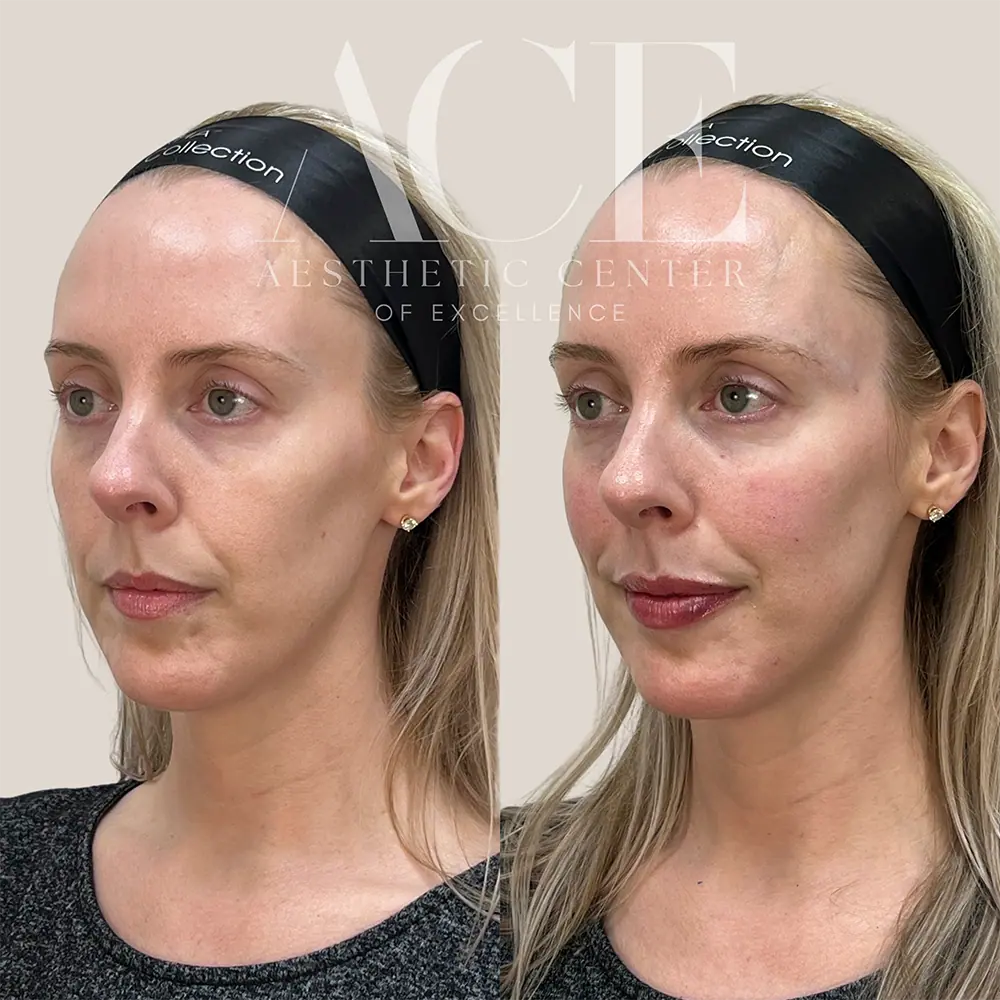 Filler and botox injectables combination treatment