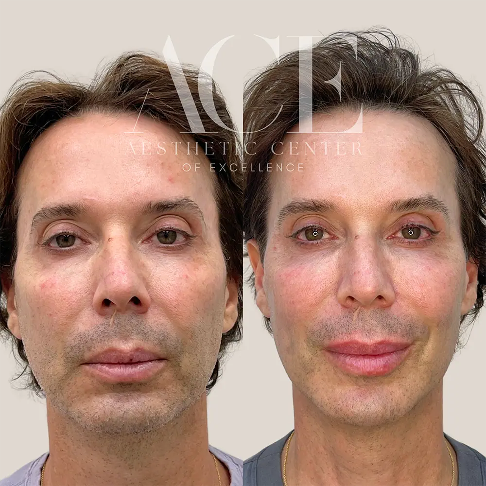 filler and botox combination treatment | Aesthetic Center of Excellence in Oklahoma City, OK