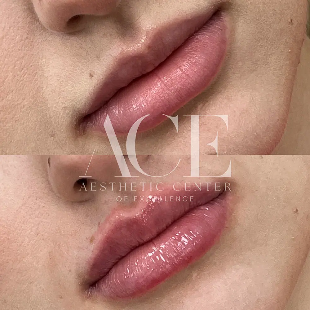 Before And After Lip Filler Treatment | Aesthetic Center of Excellence in Oklahoma City, OK