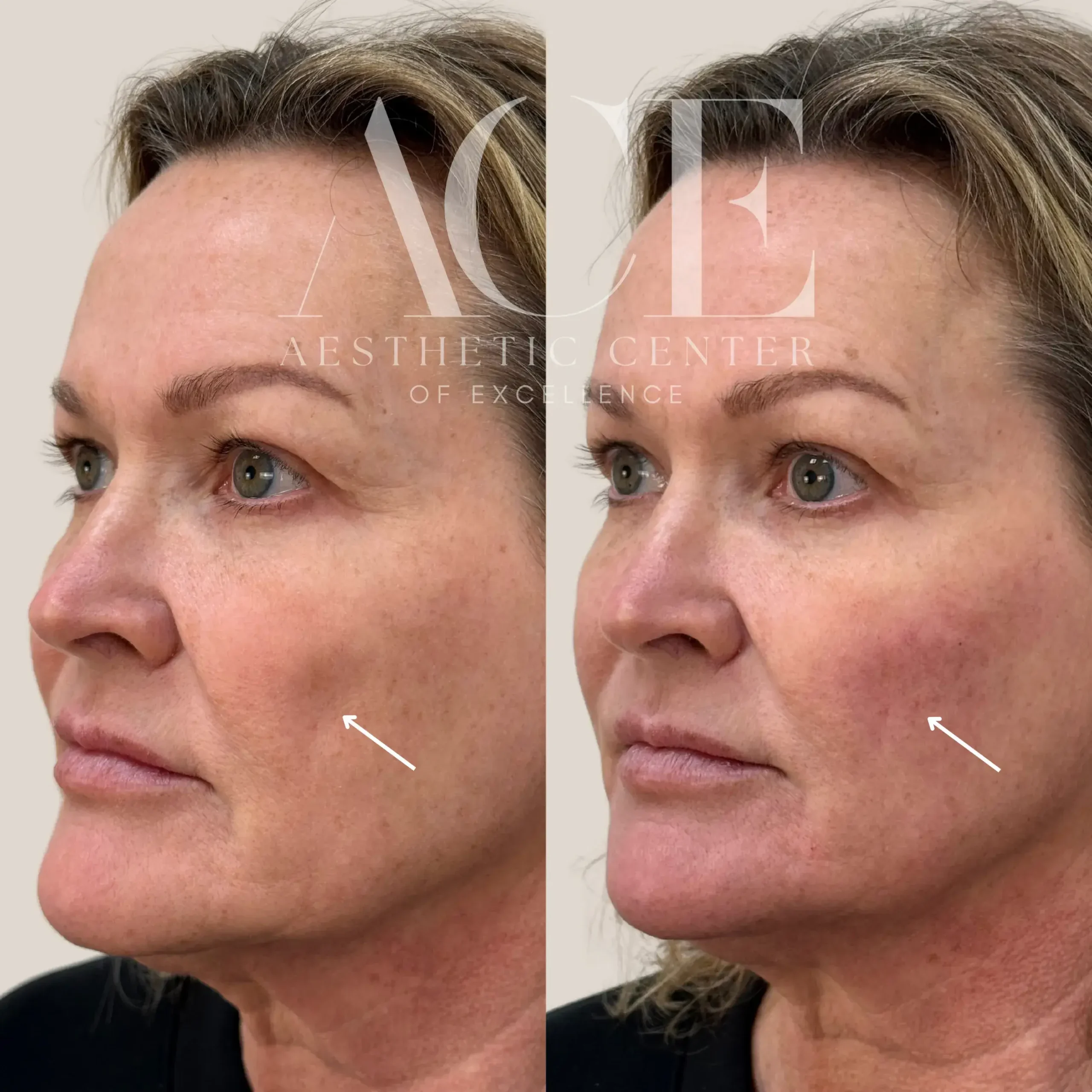 dermal filler in the cheek