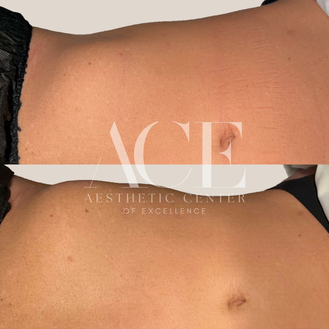 body contour with lymphatic drainage massage