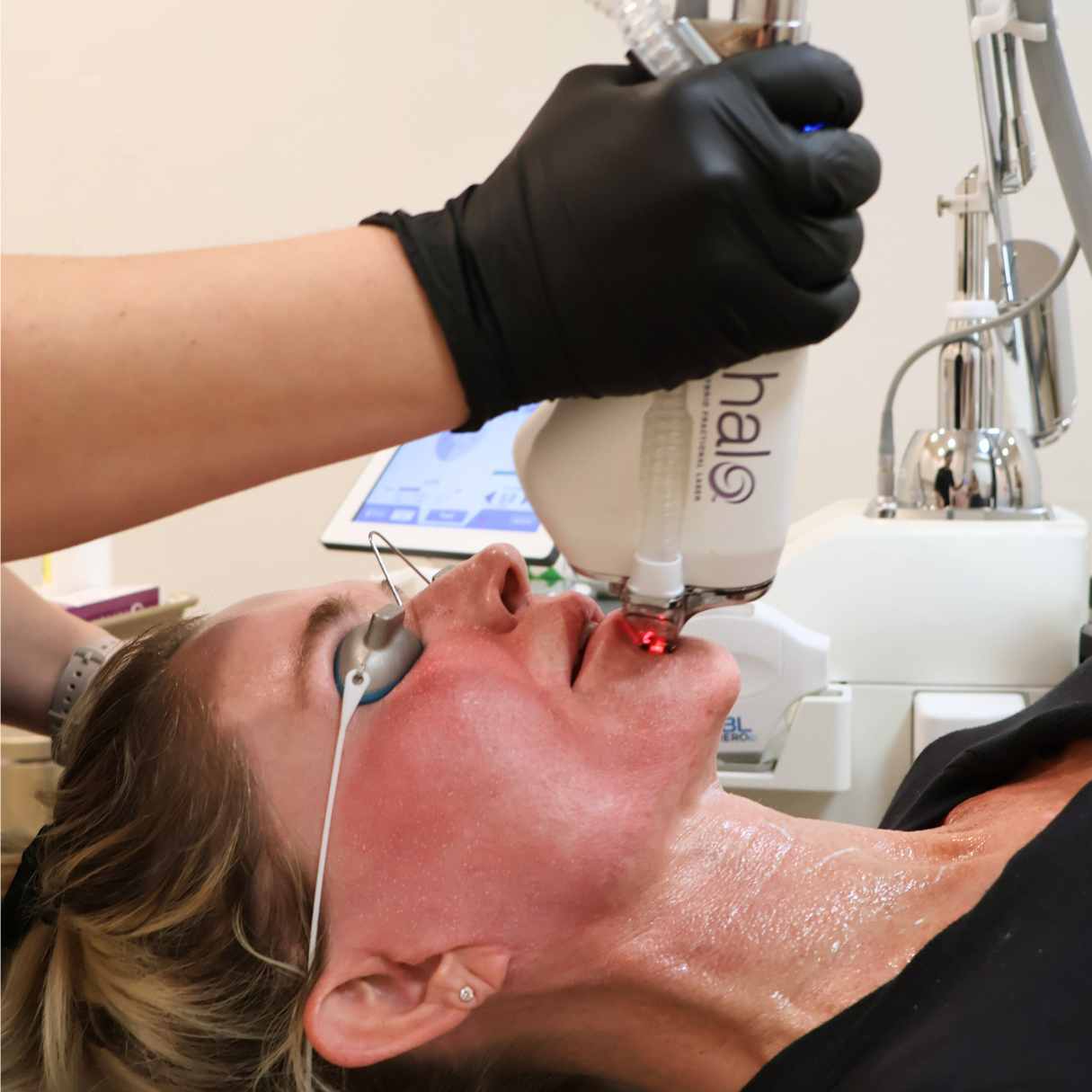 HALO treatment OKC