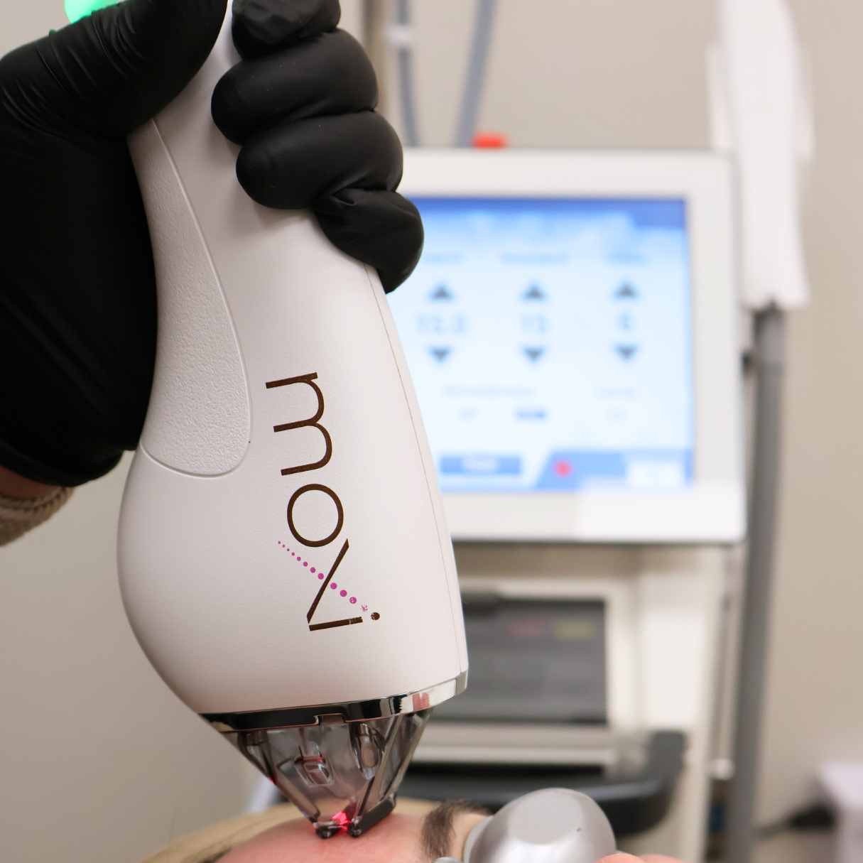 facial resurfacing okc